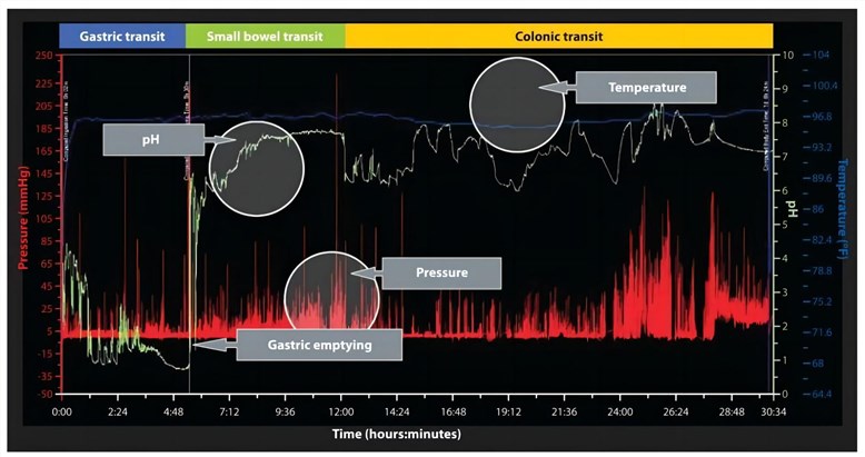 A graph illustrating the motility sample data obtained from a wireless motility capsule.